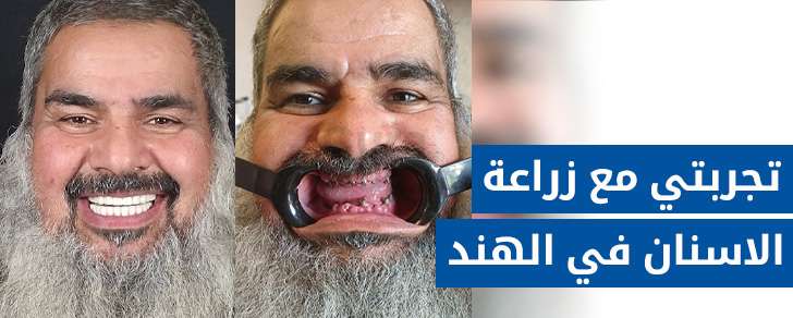 تجربتي مع زراعة الاسنان في الهند